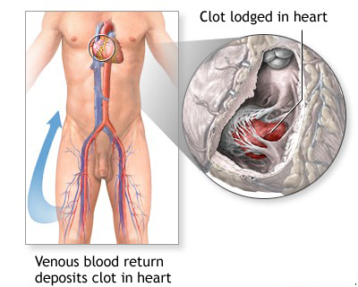 DVT Example 3
